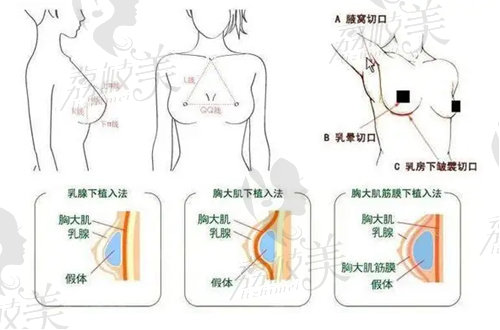 上海地区做隆胸有哪些好的医生