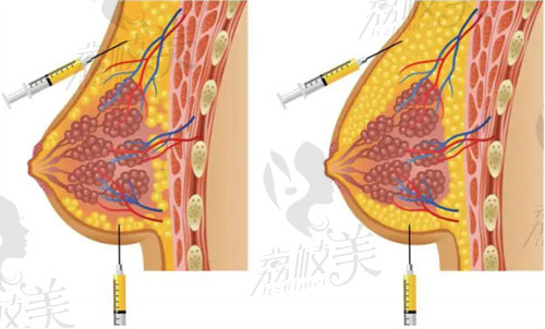 CRT自体胶原蛋白再生丰胸能维持多久？