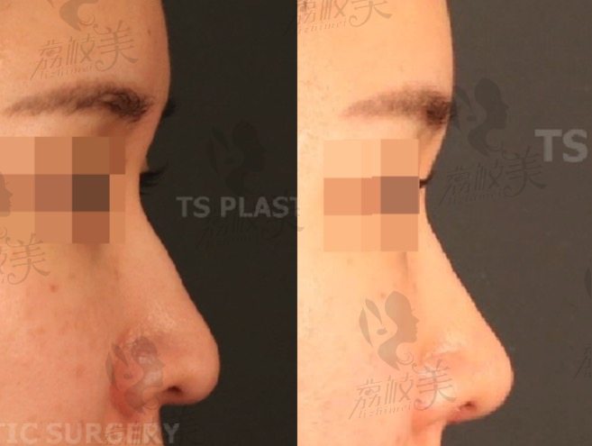 手术前/手术后7天使用耳软骨的无假体鼻部整形实例