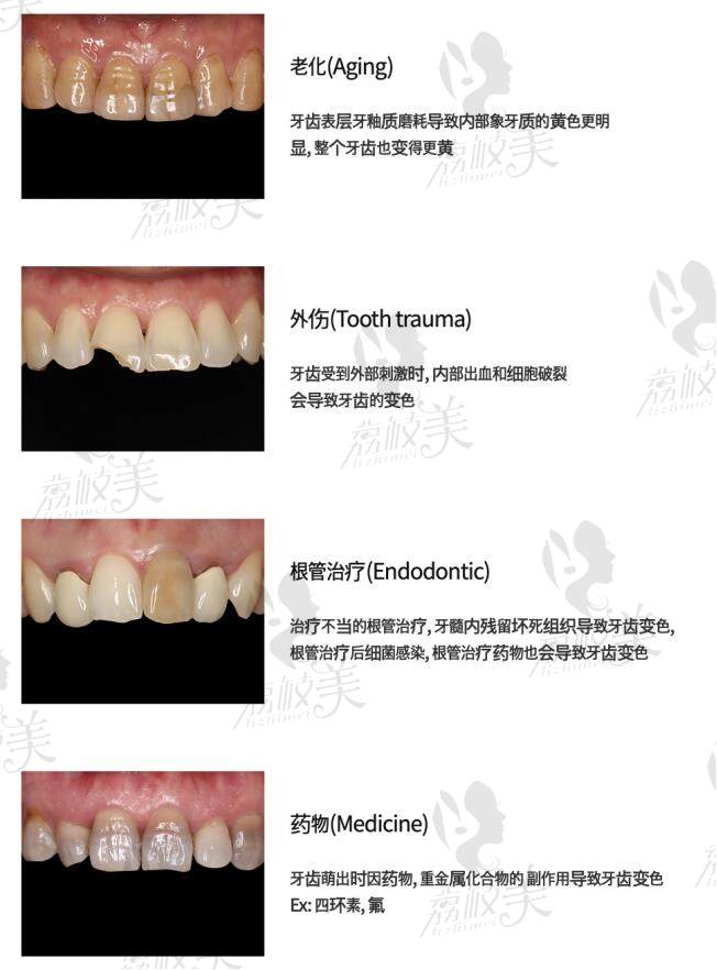 牙齿需要进行贴面治疗的类型