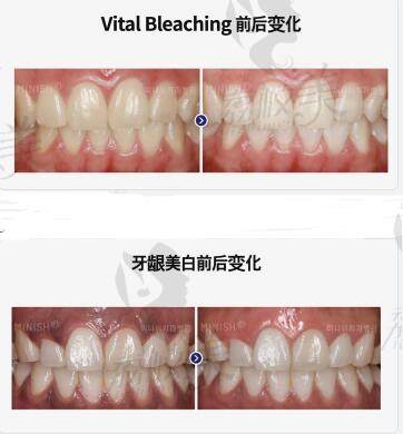 Minish牙科医院牙齿美白对比