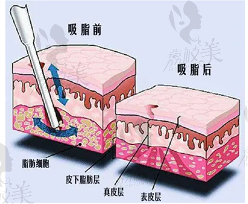 中山市禾佳吸脂技術(shù)口碑好