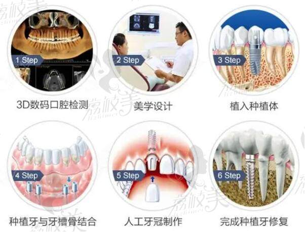 微創(chuàng)即刻種植牙的流程