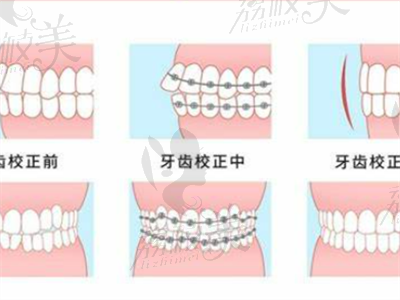 小孩牙齿矫正.png