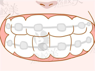 小孩牙齿矫正.png
