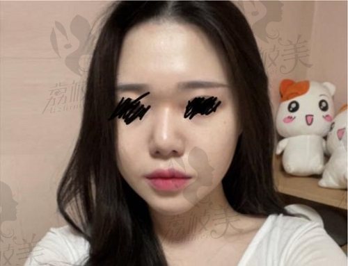 韩国优雅人朴哲佑自体肋软骨隆鼻术前 韩国优雅人朴哲佑自体肋软骨隆鼻术前