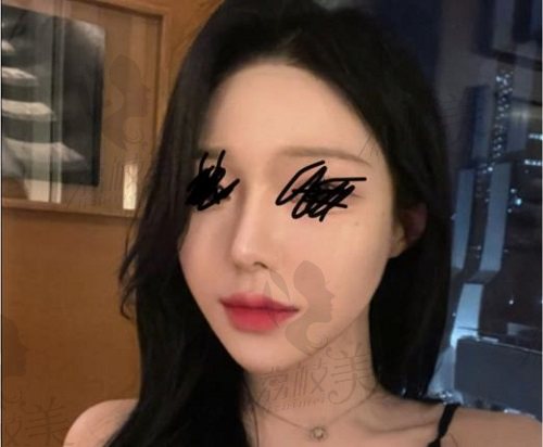 韩国优雅人朴哲佑自体肋软骨隆鼻术后 韩国优雅人朴哲佑自体肋软骨隆鼻术后