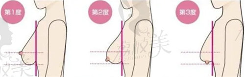杭州乳房下垂上提手术多少钱？