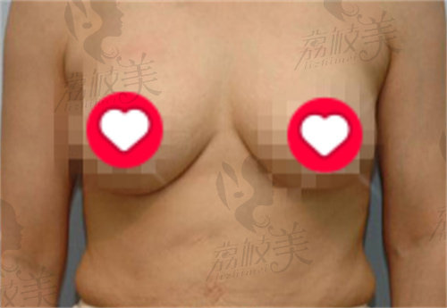韩国MD整形医院胸部下垂矫正术后