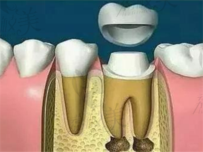 儿牙根管治疗和树脂牙冠.png