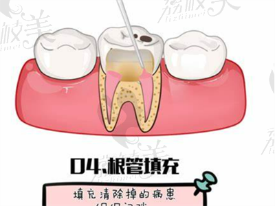 儿牙根管治疗和树脂牙冠.png