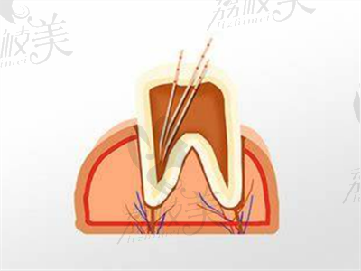 儿牙根管治疗和树脂牙冠.png