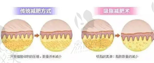 厦门欧菲陶鹏做吸脂手术不容易反弹