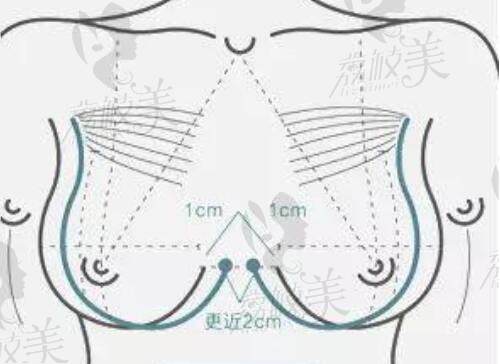 王驰隆胸美学标准测量