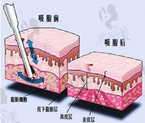 厦门欧菲吸脂技术精良