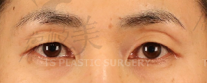 切开双眼皮手术，眼肌矫正，上眼皮脂肪重排手术改善眼窝凹陷
