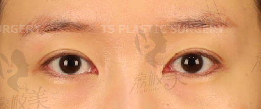切开双眼皮，上眼睑，上眼皮脂肪重排改善重叠皱纹