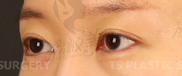 切开双眼皮，上眼角，上眼皮脂肪重排改善重叠皱纹