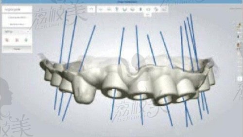 太原达美口腔数字化3D导板种植技术