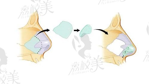 鼻整形示意