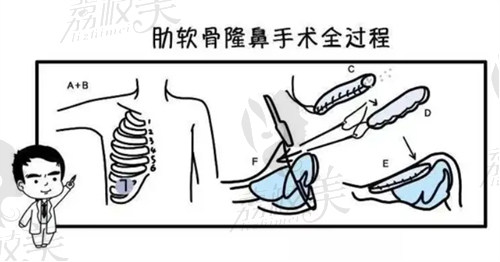 张宇医生肋软骨隆鼻技术成熟