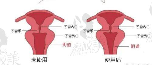 北京煤醫(yī)陰道緊縮手術(shù)示意圖