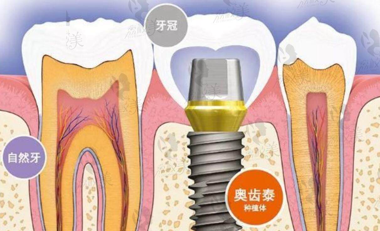 昆明松鼠口腔門診部種植牙技術(shù)