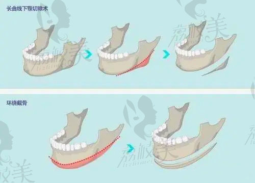 崔荣达做下颌角整形劈外板审美好