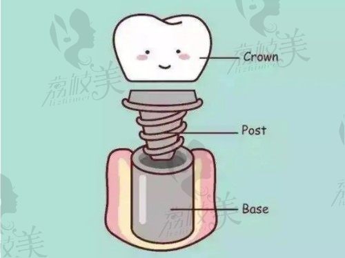 种植牙组成部分