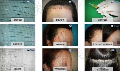 韩国JP毛发移植中心提取毛囊技术