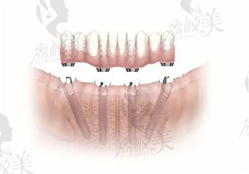 做全口种植牙后悔了，有种植牙经验的我来谈谈自己的感受   