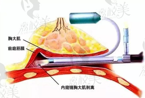 鄭州美萊姜南隆胸怎么樣