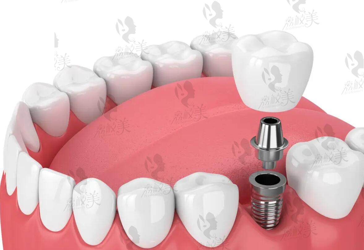 种植牙手术过程详解六步走 - 知乎