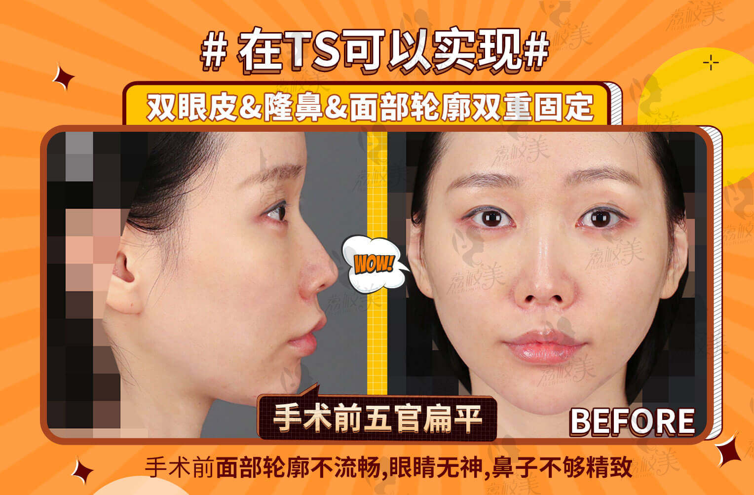 韩国TS整形医院眼鼻+面部轮廓双重固定术前