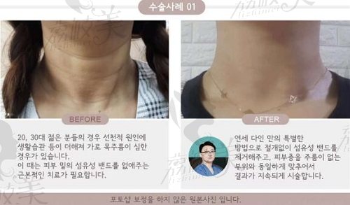 韩国延世多仁整形外科颈纹手术前后对比