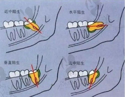 阻生智齿的种类