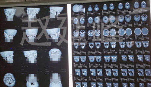 趙延峰臉骨CT分析