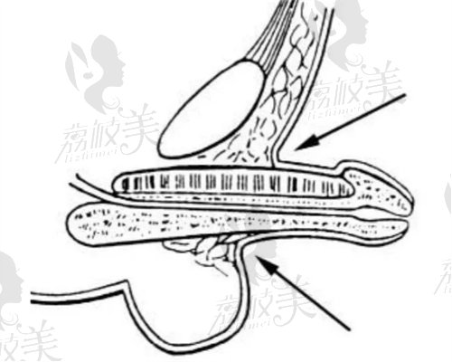 国内做阴茎延长增粗手术价格多少？