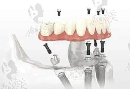 杭州美奧口腔種植牙怎么樣