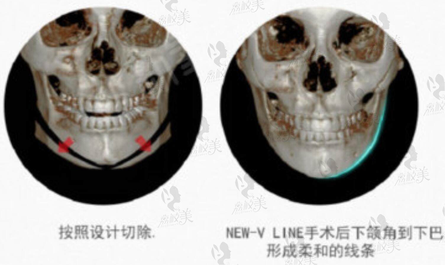 韩国绮林整形外科李承龙代表院长颌面整形技术