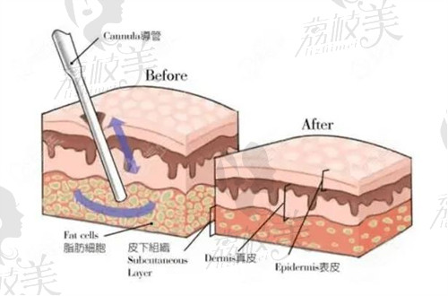 中山韓妃楊德發(fā)吸脂口碑好