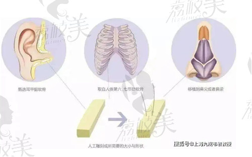 中山韩妃隆鼻技术强悍