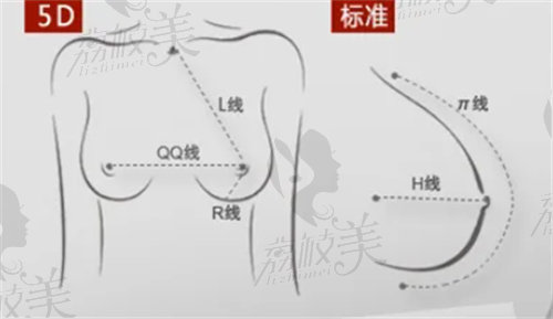 杭州瑞丽整形医院做假体隆胸价格多少钱？