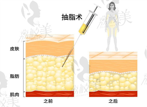 厦门欧菲医生吸脂技术掌握到位