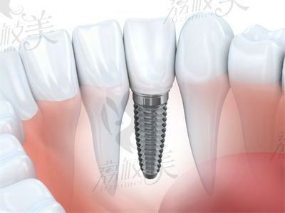 种植牙都有哪些品牌？费用便宜又寿命长的牌子哪个比较好.png
