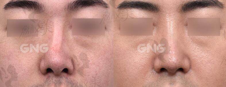 韩国gng整形医院鼻整形无假体隆鼻术对比