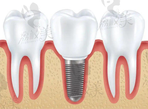 北京芽美口腔种植牙技术优势