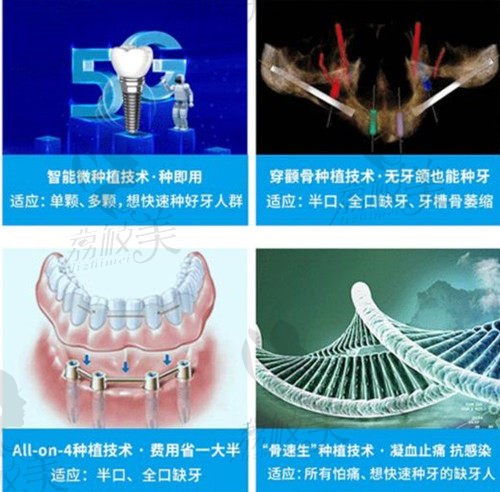 廣州穗華口腔醫(yī)院種植牙