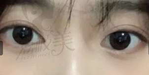 韩国LINK林克整形双眼皮评价2.png