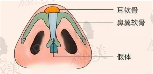 中山韩妃刘健医生耳软骨隆鼻技术扎实